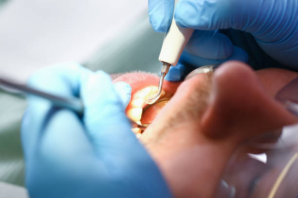 Best Emergency Wisdom Teeth Removal in Henryetta, OK