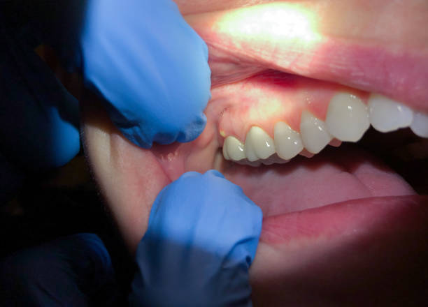 Best Emergency Tooth Extraction in Henryetta, OK